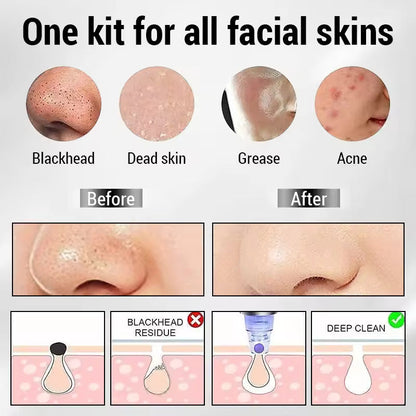 Electric Blackhead Acne Oil Remover