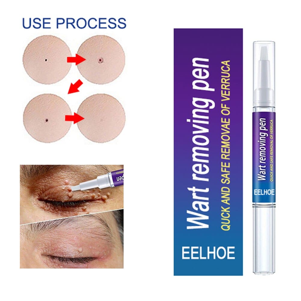 Warts Remover Original Cream Wart Removal